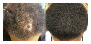 Before and after hair heath therapy
