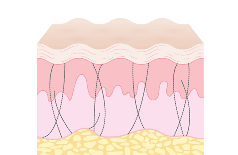 Microneedling induces collagen production