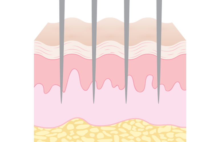 Microneedling Step 1
